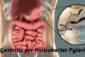 gastritis por Helicobacter Pylori